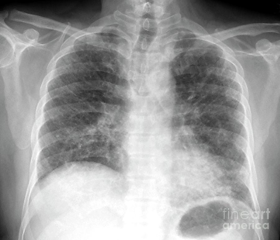 Pulmonary Fibrosis Photograph by Science Photo Library - Pixels