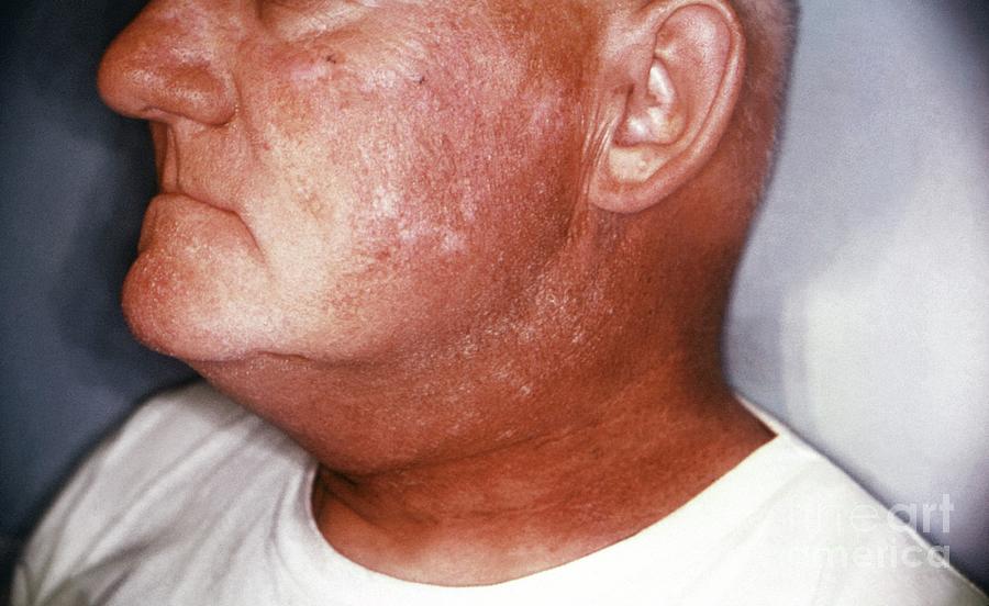 Radiation Dermatitis Of The Face Photograph by Cdc/science Photo