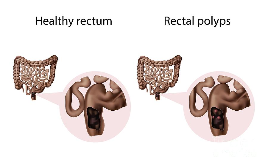 Rectal Polyps And Healthy Rectum Photograph By Veronika Zakharova 1921