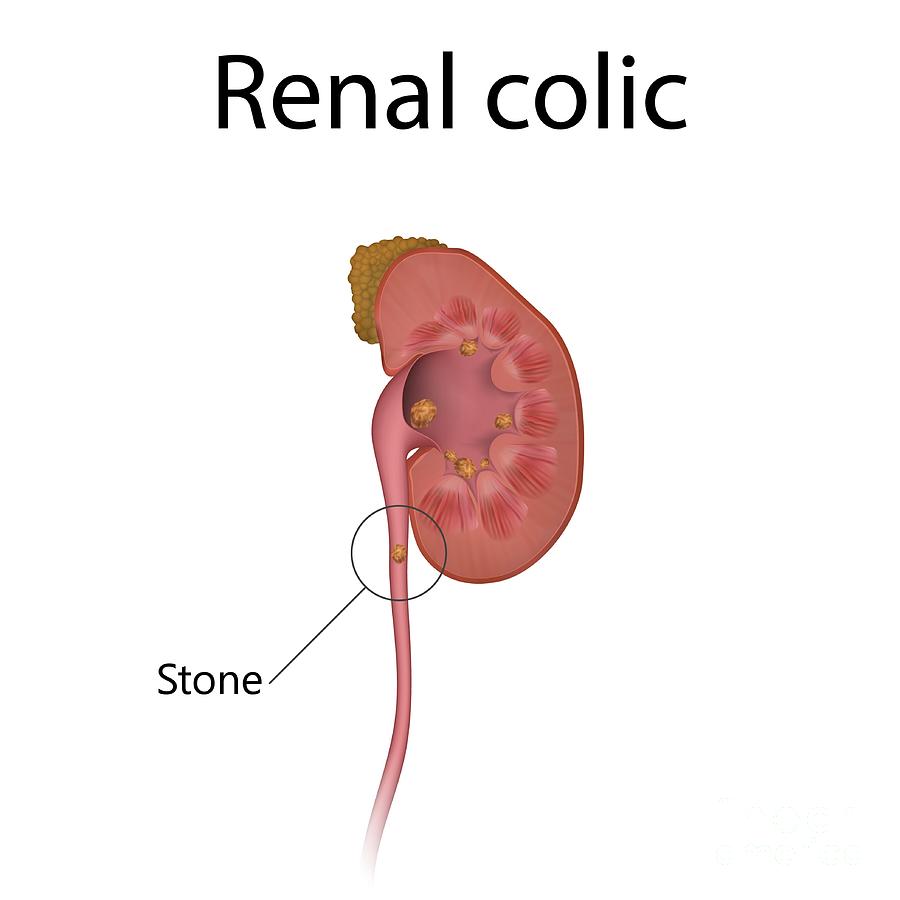 renal colic veronika zakharovascience photo library