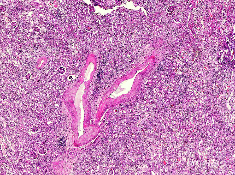 Renal Pressure Atrophy Photograph by Nigel Downer/science Photo Library
