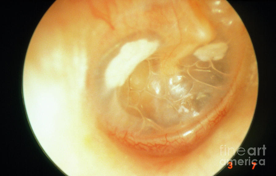 Resolving Acute Otitis Media Photograph by Professor Tony Wright, Institute Of Laryngology & Otology/science Photo Library