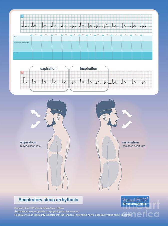 Respiratory Sinus Arrhythmia Photograph by Chongqing Tumi Technology ...