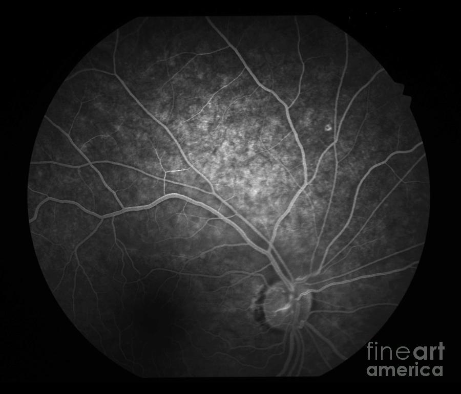 Retinal Vasculitis by Science Photo Library