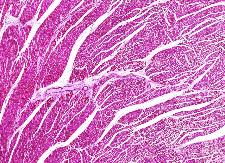 Rheumatic Myocarditis Photograph by Nigel Downer/science Photo Library ...