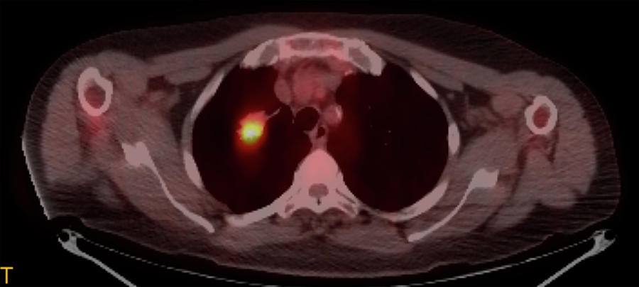 Right Upper Lobe Lung Carcinoma, Pet-ct Photograph by Steven Needell