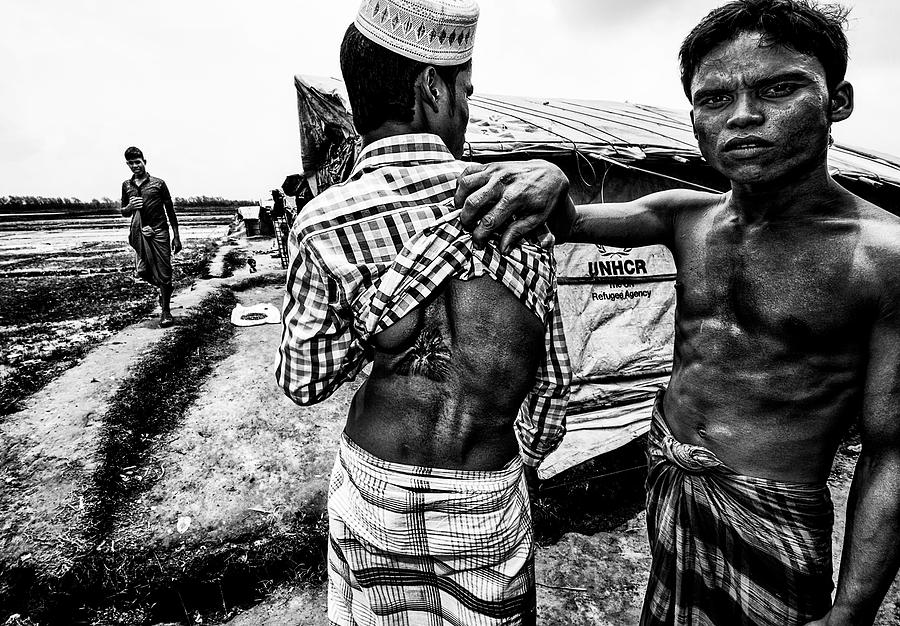 Rohingya Refugee Showing The Impact Of A Bullet In His Friend´s Body ...