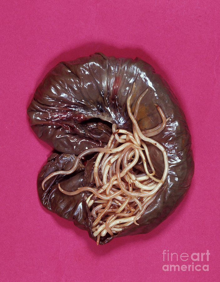 Roundworm Obstruction Photograph by Dr M.a. Ansary/science Photo Library
