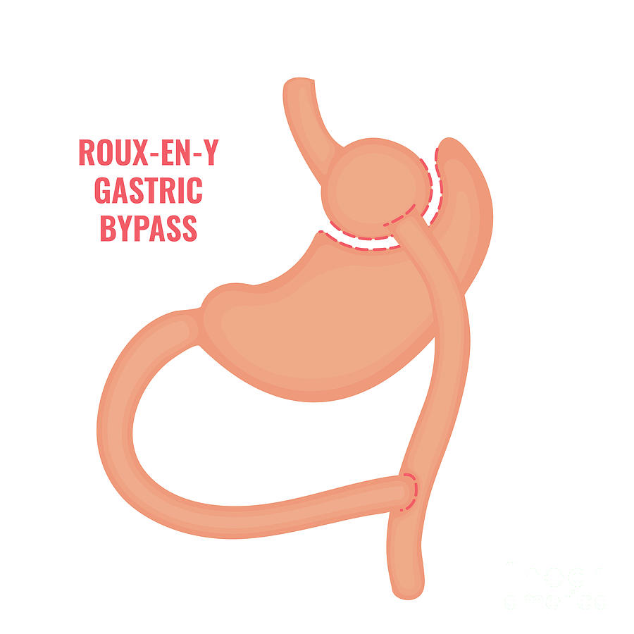 Roux-en-y Gastric Bypass Bariatric Surgery Photograph by Art4stock/science Photo Library