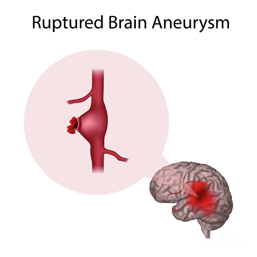 ruptured-brain-aneurysm-photograph-by-veronika-zakharova-science-photo