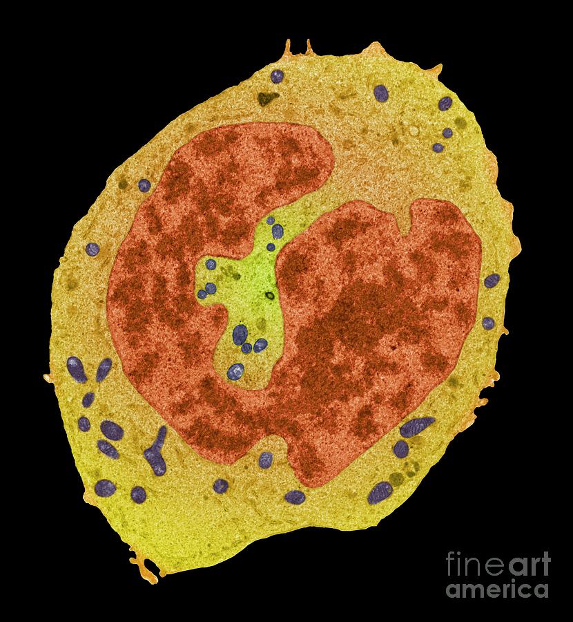 Sarcoma Cancer Cell Photograph by Steve Gschmeissner/science Photo Library