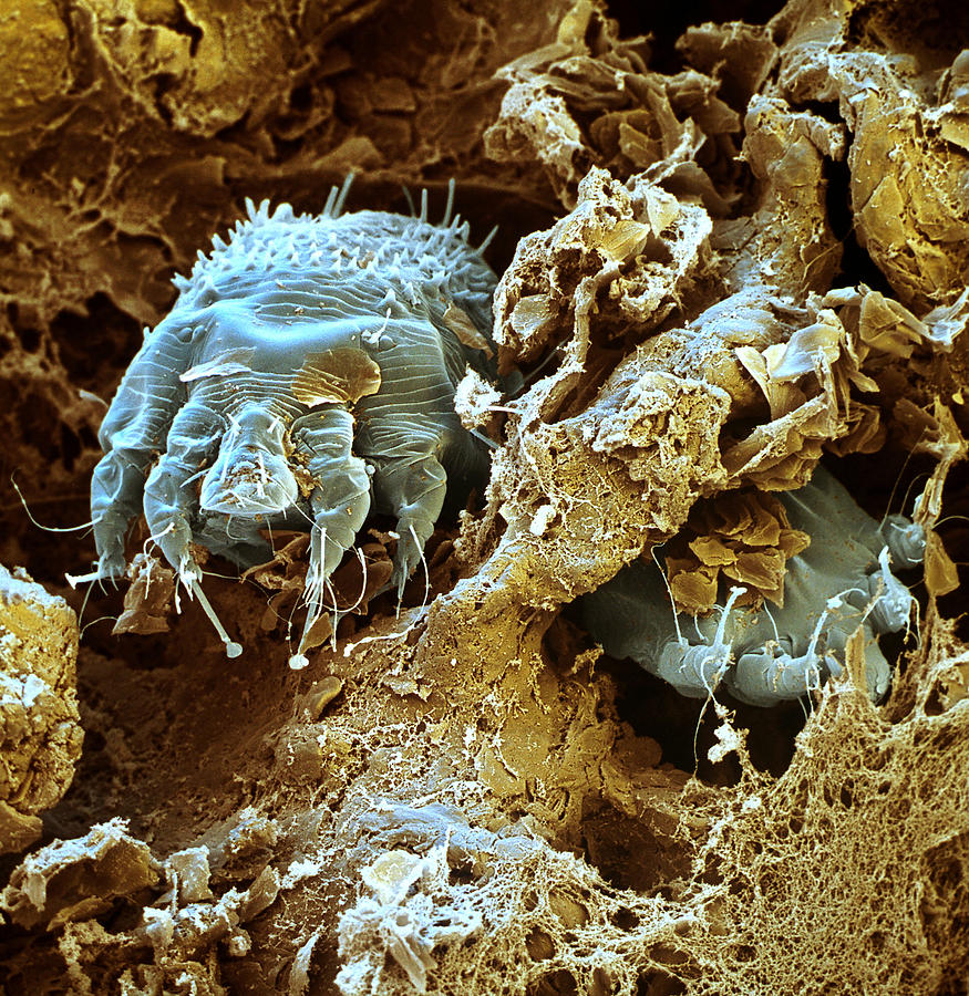 Scabies Parasite Photograph by Oliver Meckes EYE OF SCIENCE