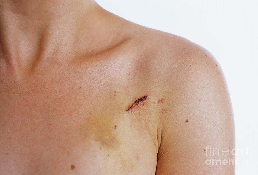 Scar From Pacemaker Operation Photograph by Daniel Sambraus/science Photo Library