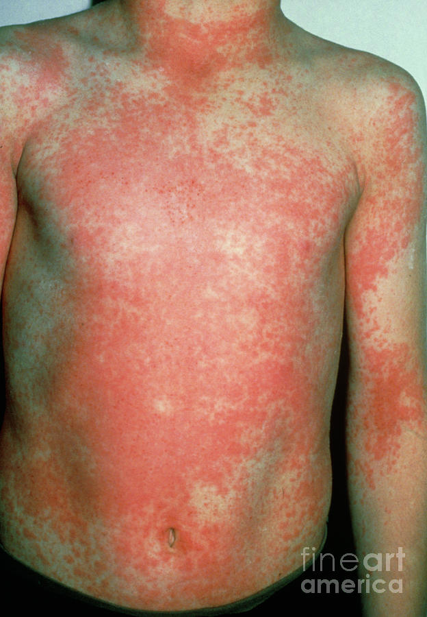 scarlet-fever-rash-photograph-by-biophoto-associates-science-photo-library