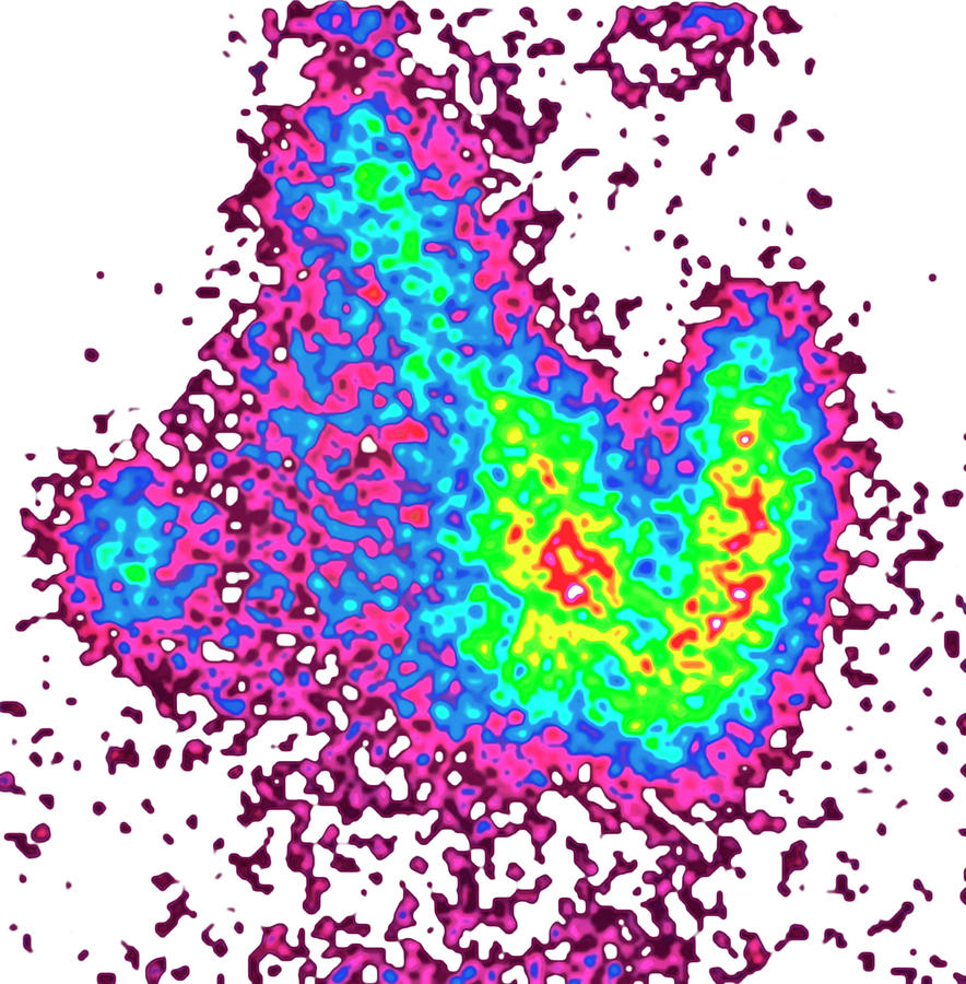 Scintigraphy thyroid gland by picturetom Scintigraphy thyroid gland by picturetom