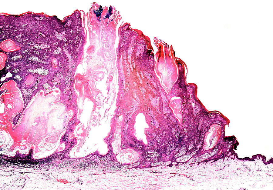 Seborrheic Keratosis Photograph By Nigel Downer Science Photo Library