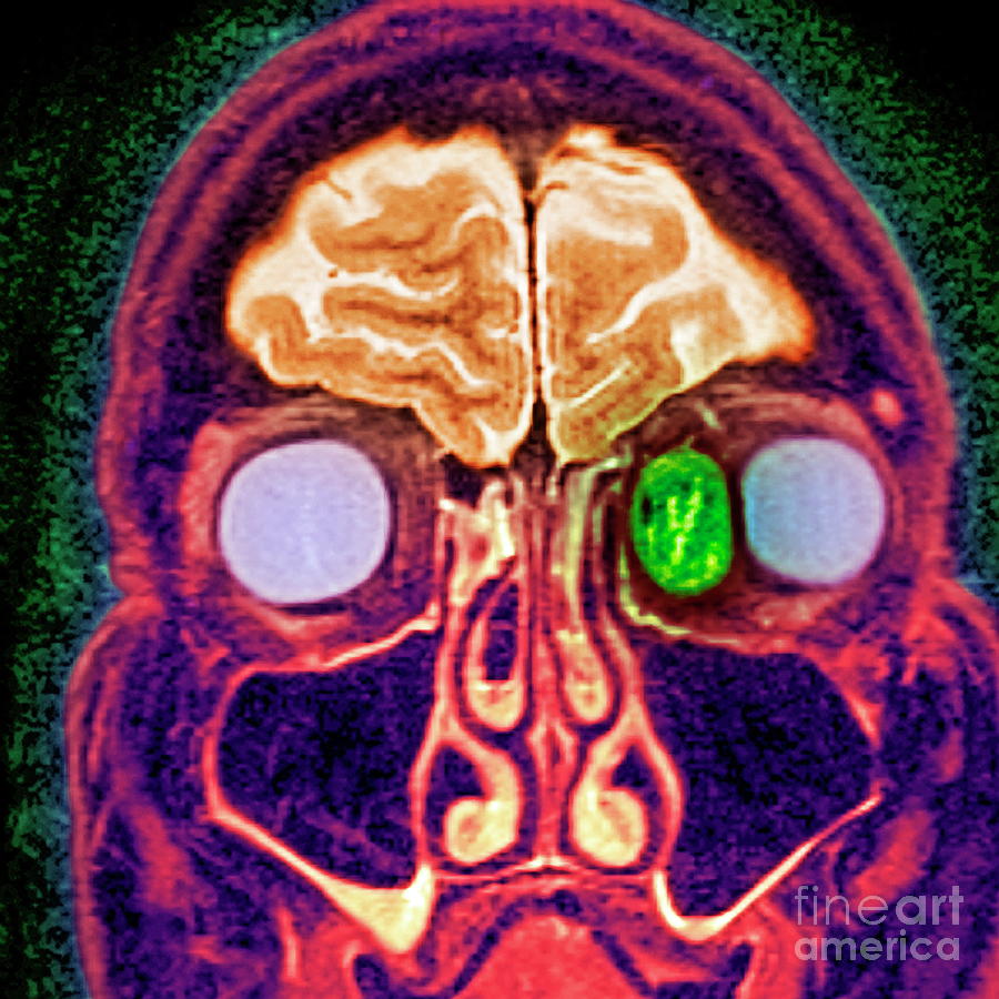 Secondary Cancer Photograph By Simon Fraser, Newcastle Hospitals Nhs ...