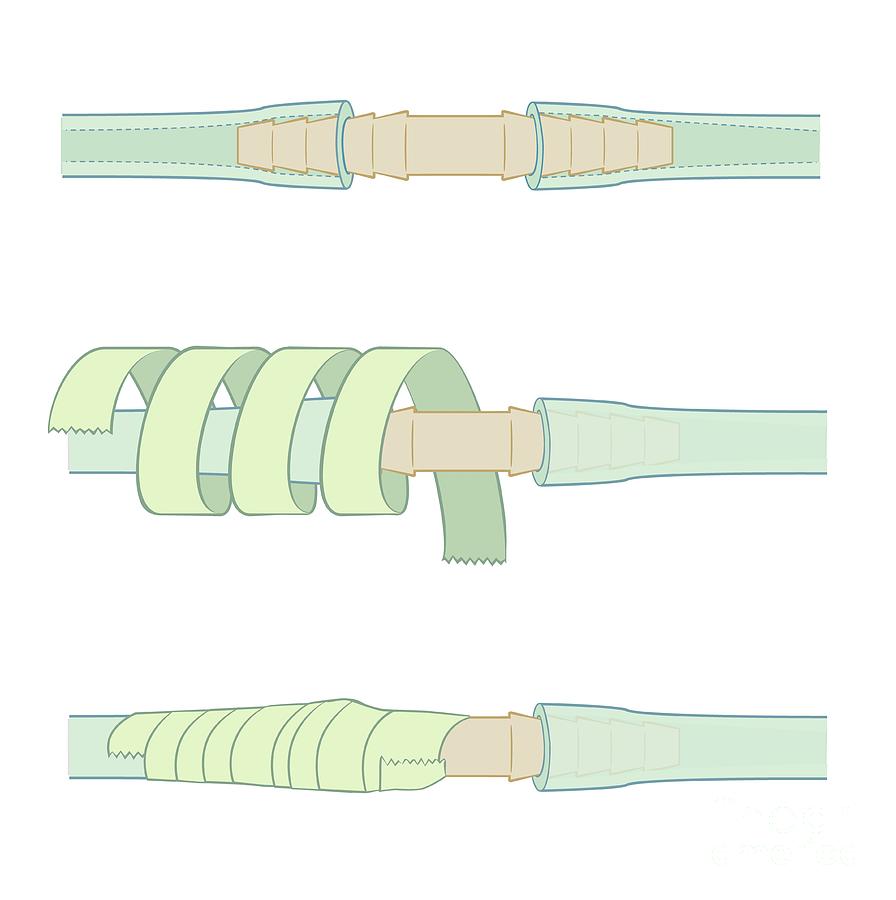 Securing Chest Drainage Tube Photograph by Jeanette Engqvist/science ...