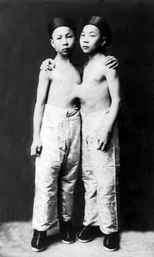 Seng-sen And Tang-sen Liou, Conjoined Photograph by Science Source