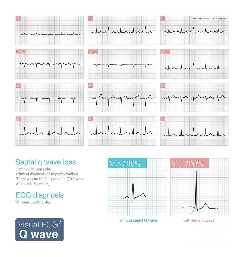 Septal Q Wave Loss Photograph by Chongqing Tumi Technology Ltd/science ...