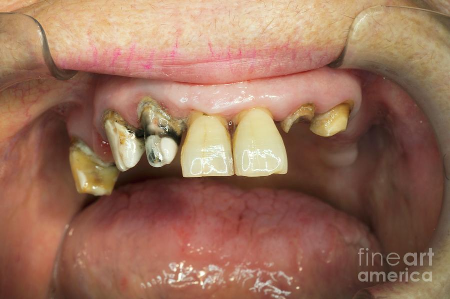 Severe Tooth Decay Photograph By Dr Armen Taranyanscience Photo Library