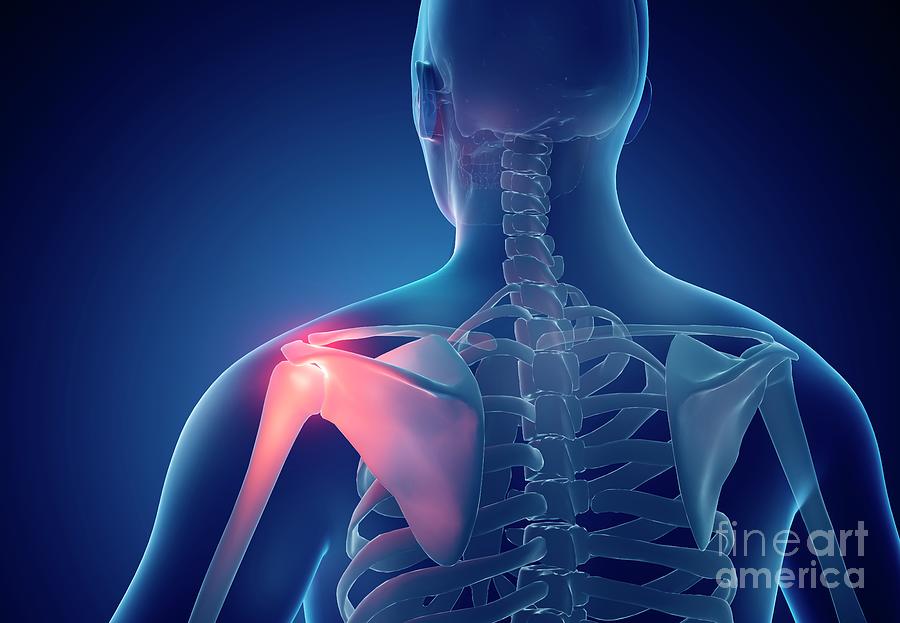 Shoulder Injury Photograph by Artur Plawgo / Science Photo Library