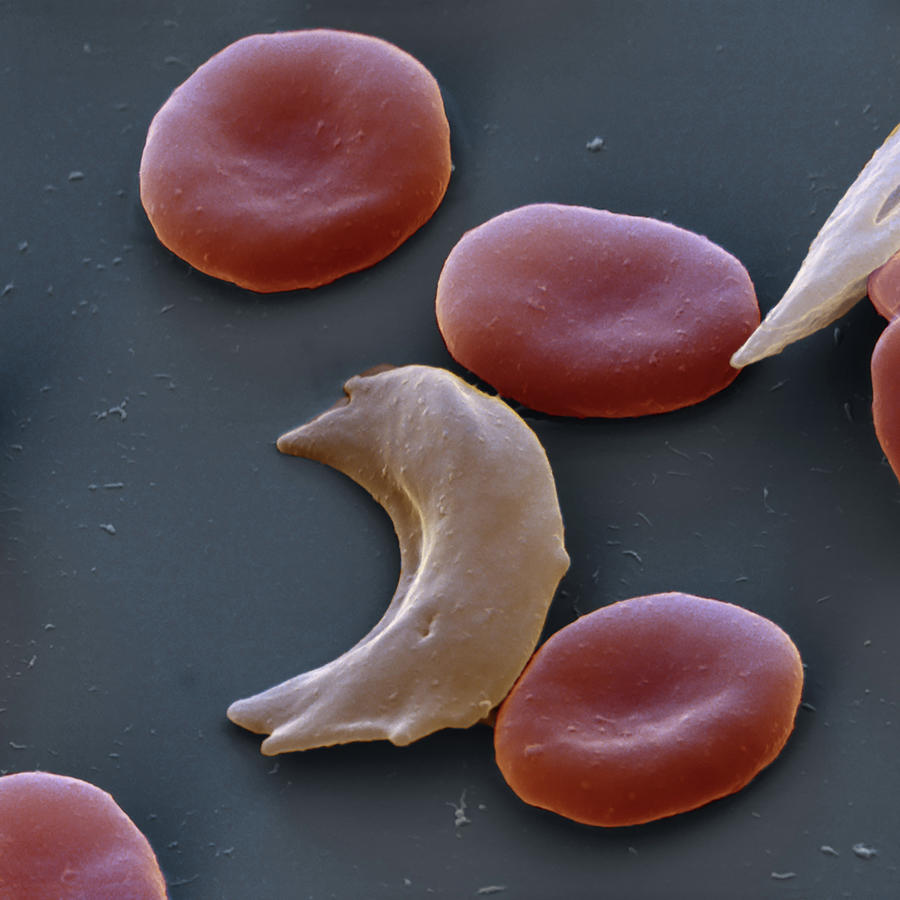 Sickle Cell Anemia, Sem Photograph by Oliver Meckes EYE OF SCIENCE