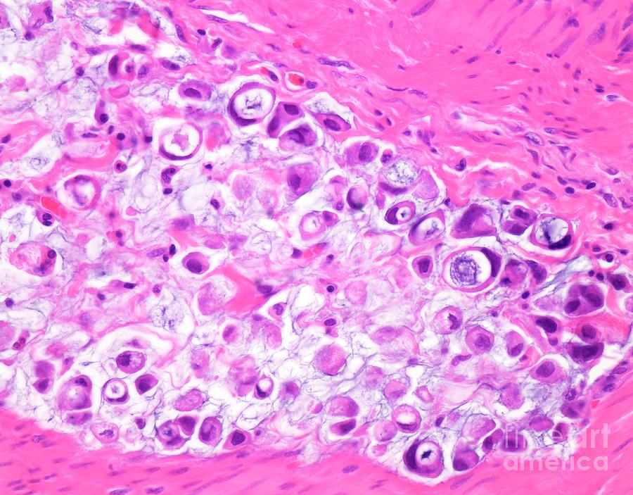 Signet Ring Cell Carcinoma Of The Colon Photograph By Webpathologyscience Photo Library 4372