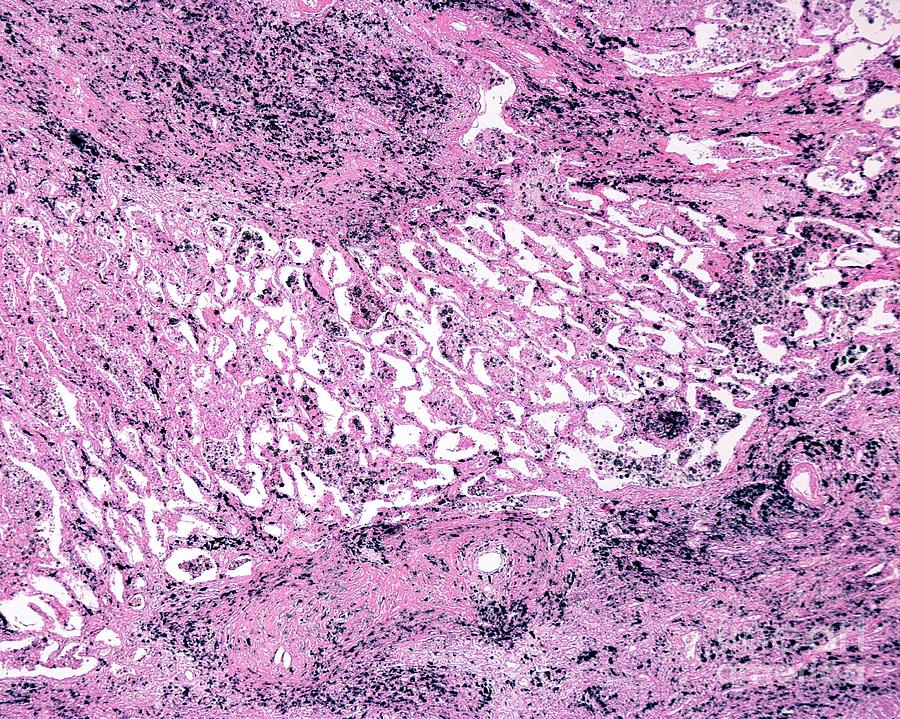 Silicotic Lung Photograph By Jose Calvoscience Photo Library