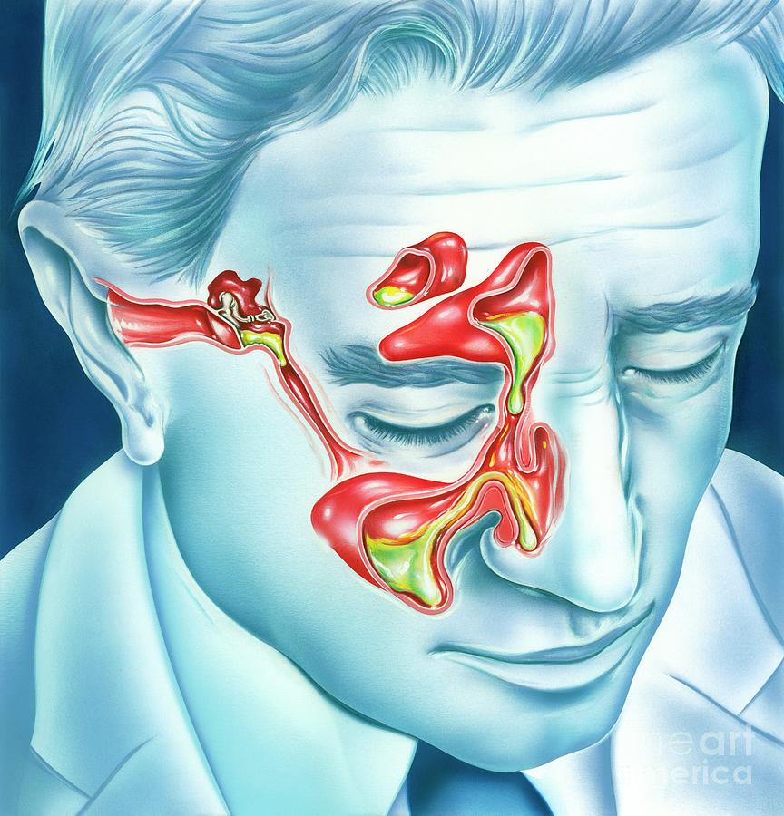 Sinus And Ear Infections by John Bavosi/science Photo Library