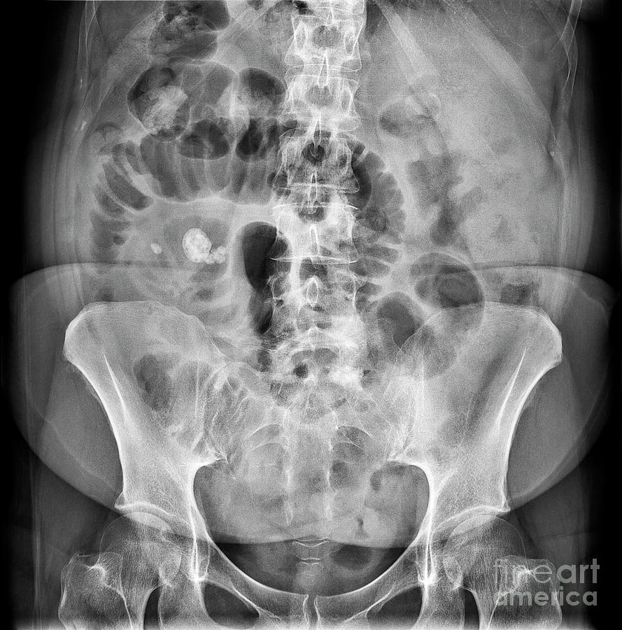 Situs Inversus Photograph by Science Photo Library - Pixels