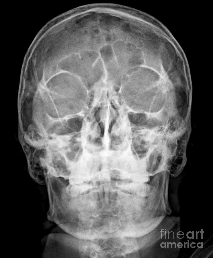 Skull With Multiple Myeloma Photograph By Rajaaisya Science Photo Library Pixels