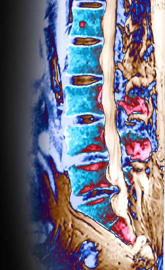Slipped Disc Photograph by Gjlp/science Photo Library