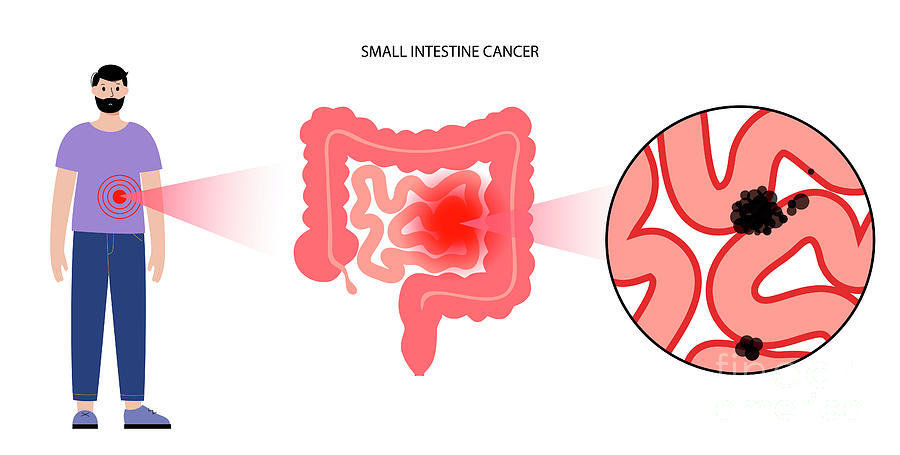 Small Intestine Cancer Photograph by Science Photo Library Small Intestine Cancer Photograph by Science Photo Library