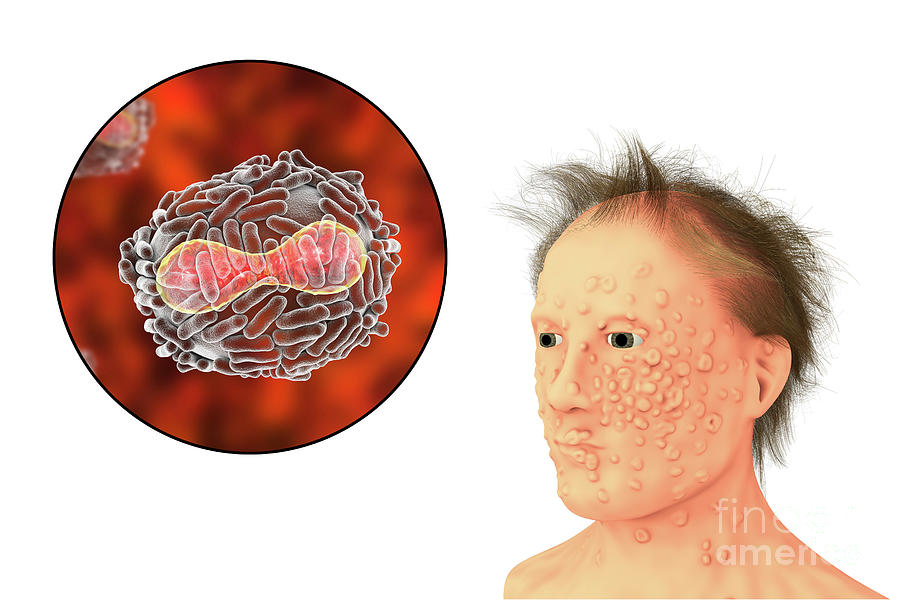 Smallpox Virus And Disease Photograph By Kateryna Kon Science Photo Library Fine Art America