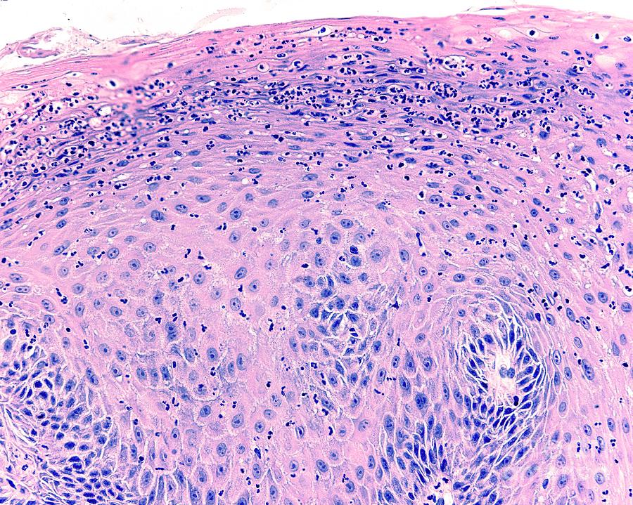 Soft Palate Papilloma Photograph by Jose Calvo/science Photo Library ...