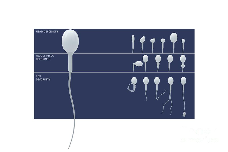 Sperm Deformity Classification Photograph by Claus Lunau/science Photo Library