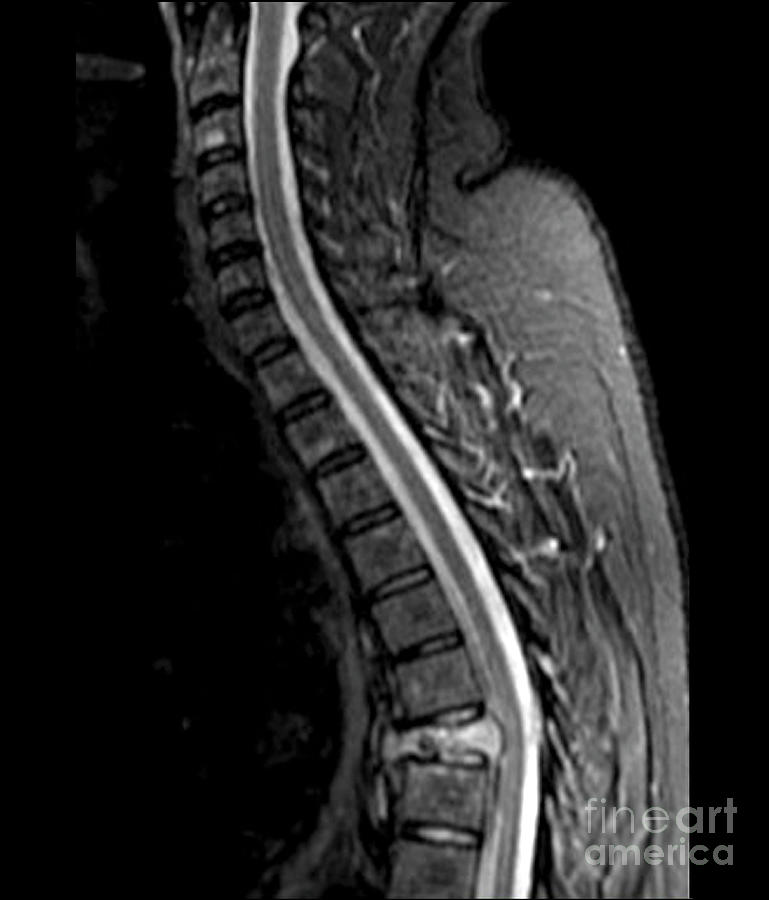 Spinal Cancer Photograph by Zephyr/science Photo Library - Fine Art America