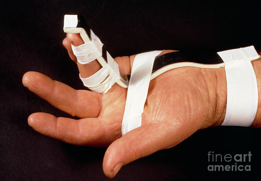 broken middle finger splint