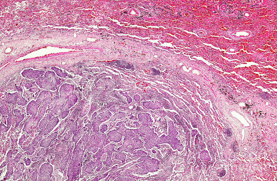 Squamous Cell Carcinoma Of The Lung Photograph by Nigel Downer/science ...