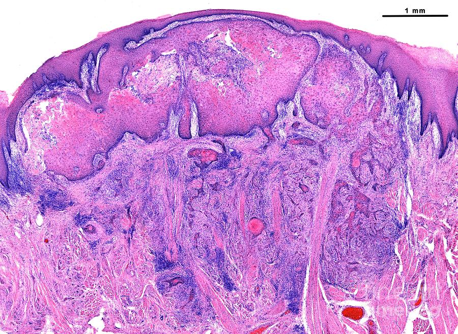 Squamous Cell Carcinoma Of The Tongue Photograph by Jose Calvo/science Photo Library