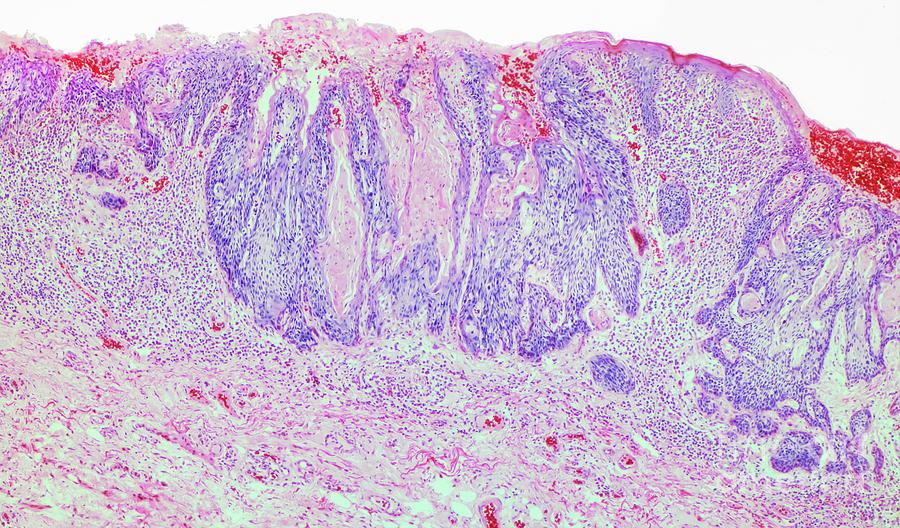 Squamous Cell Carcinoma Photograph by Steve Gschmeissner/science Photo ...