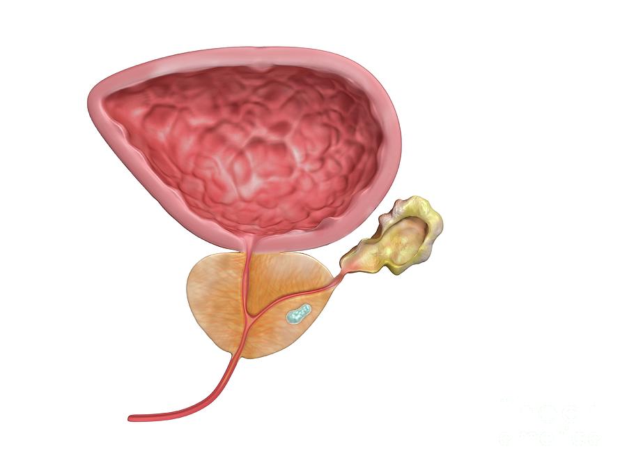 Stage I Prostate Cancer Photograph by Science Photo Library Stage I Prostate Cancer Photograph by Science Photo Library