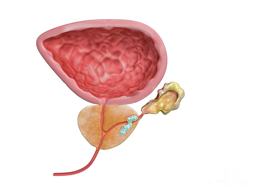 stage-ii-prostate-cancer-photograph-by-gunilla-elam-science-photo