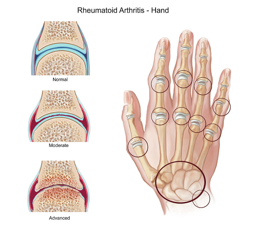 Stages Of Rheumatoid Arthritis On Hand Photograph by Elise Walmsley Mac-Wha