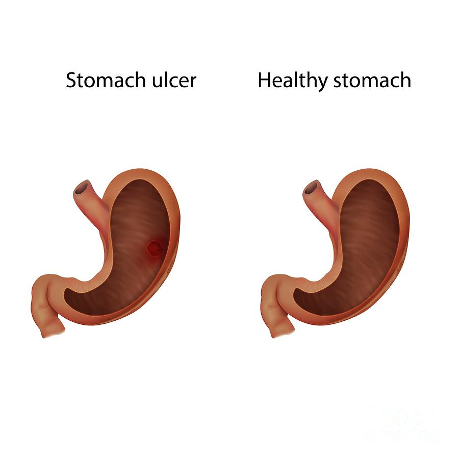 Stomach Ulcer And Healthy Stomach Photograph By Veronika Zakharovascience Photo Library 4023