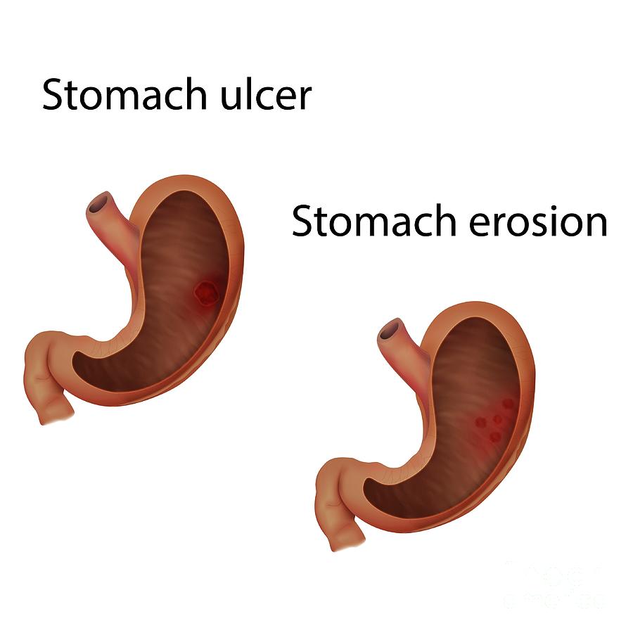 Stomach Ulcer And Stomach Erosion Photograph By Veronika Zakharova 