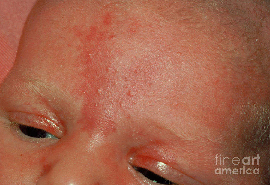 Stork Mark Birthmark On Baby's Forehead Photograph by Science Photo Library