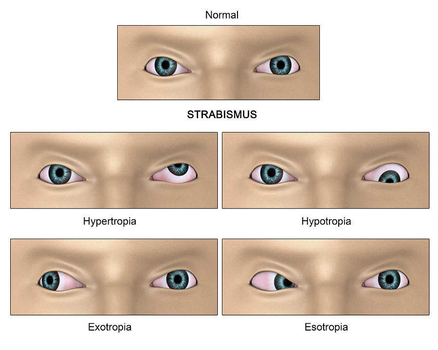 strabismus-diagram-a-condition-where-photograph-by-stocktrek-images