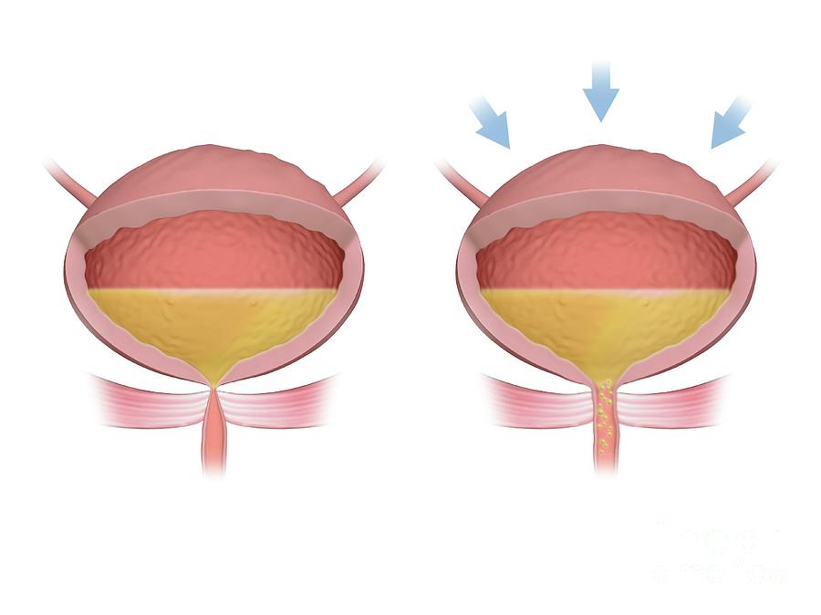 Stress Incontinence Photograph by Maurizio De Angelis/science Photo ...